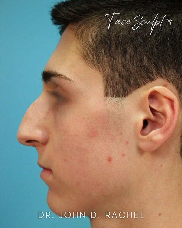 Rhinoplasty