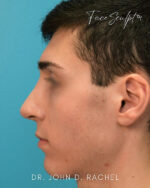 Rhinoplasty