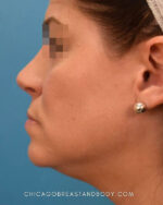 Rhinoplasty