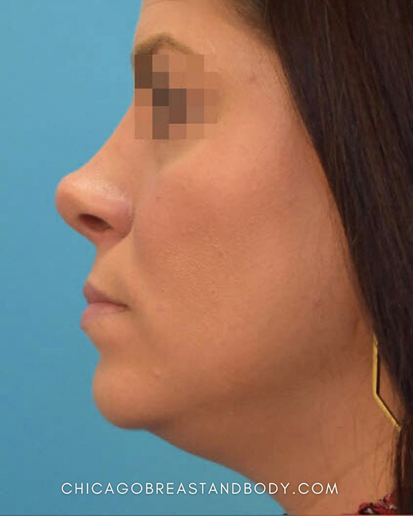 Rhinoplasty