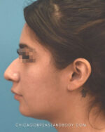 Rhinoplasty