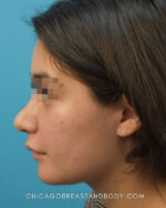 Rhinoplasty