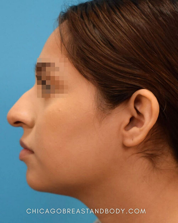 Rhinoplasty