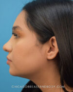 Rhinoplasty