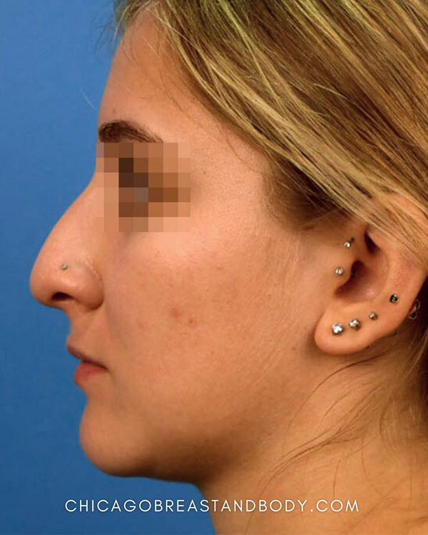 Rhinoplasty