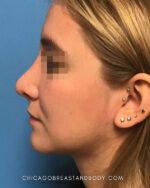 Rhinoplasty