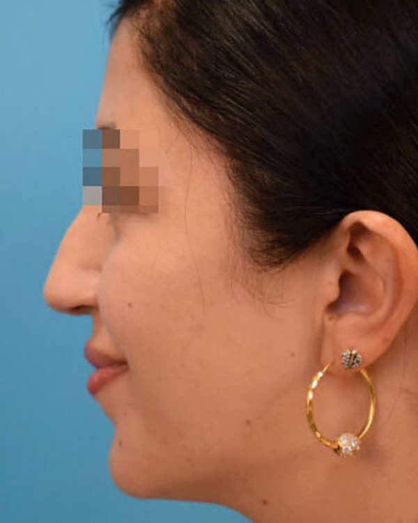 Rhinoplasty