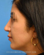 Rhinoplasty