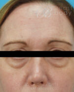 Eyelid Surgery