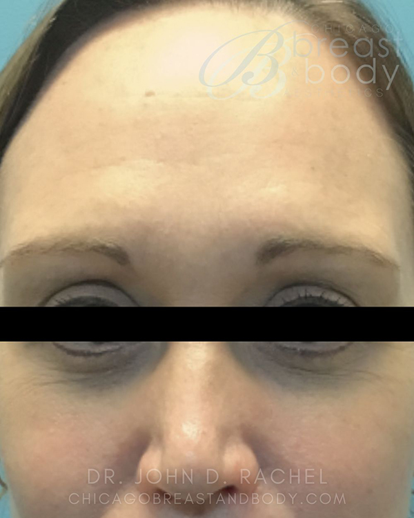 Eyelid Surgery