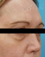 Eyelid Surgery