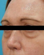 Eyelid Surgery