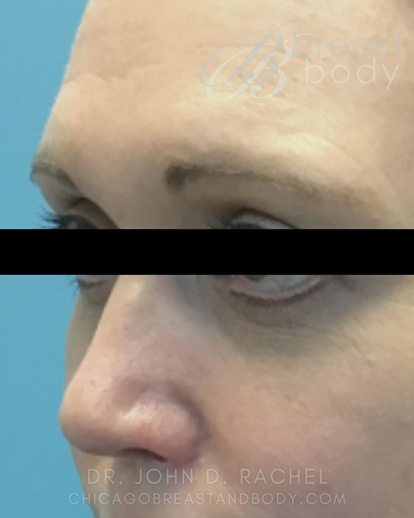 Eyelid Surgery