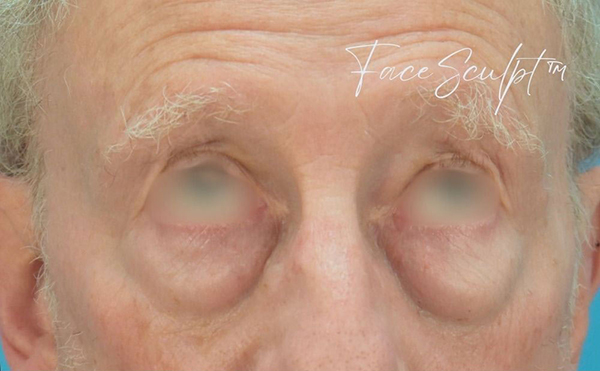 Eyelid Surgery