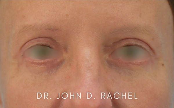 Eyelid Surgery