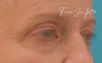 Eyelid Surgery