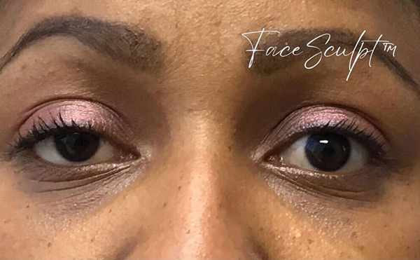 Eyelid Surgery