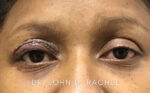 Eyelid Surgery