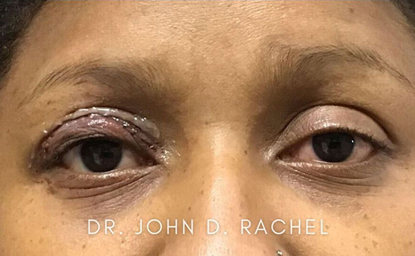 Eyelid Surgery