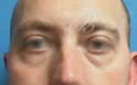 Eyelid Surgery