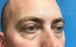 Eyelid Surgery