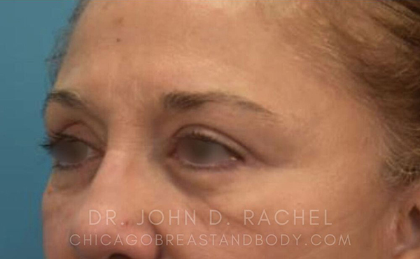 Eyelid Surgery