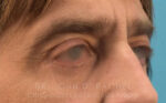 Eyelid Surgery