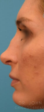 Rhinoplasty