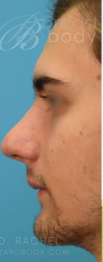 Rhinoplasty