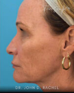 Rhinoplasty