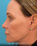 Rhinoplasty