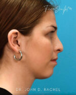 Rhinoplasty