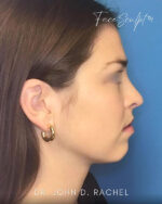 Rhinoplasty