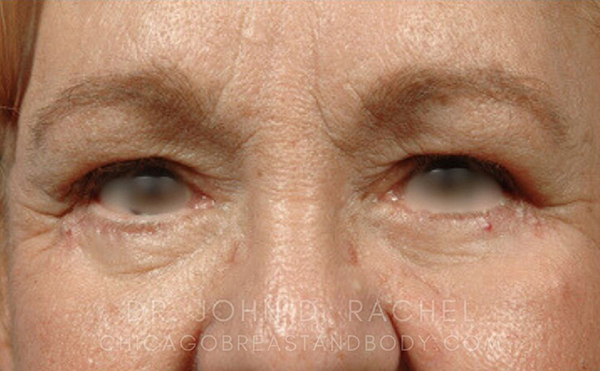 Eyelid Surgery