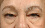 Eyelid Surgery