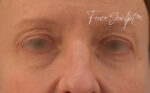 Eyelid Surgery