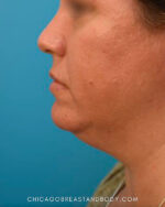 Chin & Neck Liposuction