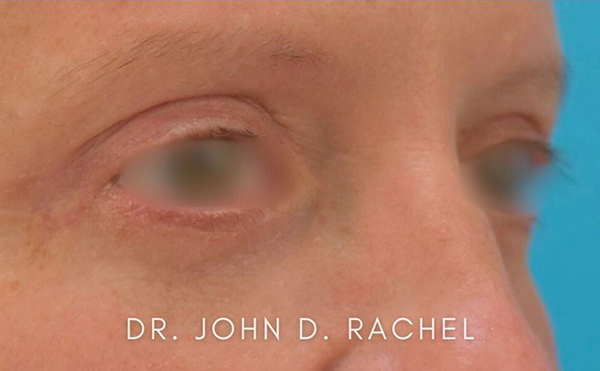 Eyelid Surgery